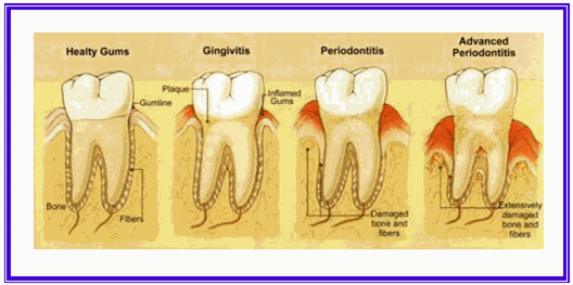Gingivitis and Periodontitis 1