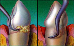 Gingivitis and Periodontitis 10