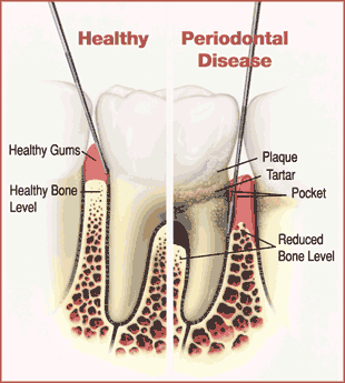 Gingivitis and Periodontitis 2