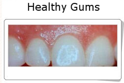 Gingivitis and Periodontitis 3