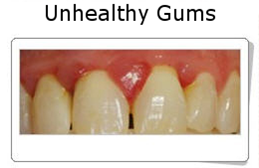 Gingivitis and Periodontitis 4