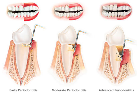 Gingivitis and Periodontitis 5