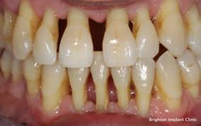 Gingivitis and Periodontitis 6