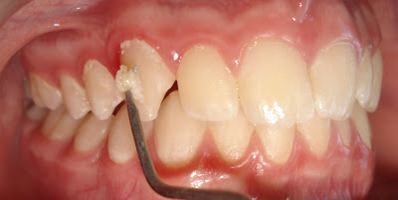 Gingivitis and Periodontitis 7