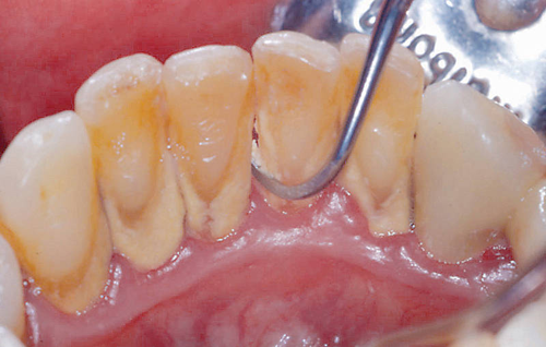 Gingivitis and Periodontitis 8
