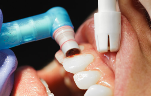 Gingivitis and Periodontitis 9