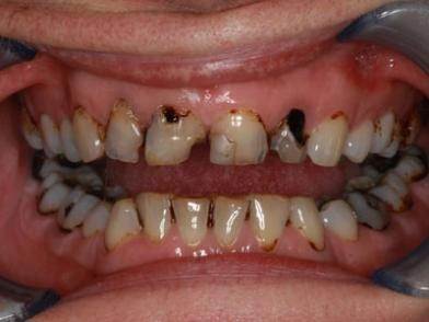 What Are Cavities 1