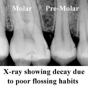 What Are Cavities 2