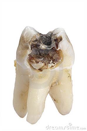 What Are Cavities 5