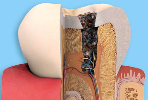 What Are Cavities 6