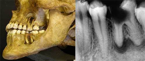 What Are Cavities 7