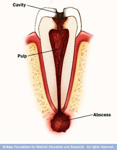 What Are Cavities 8