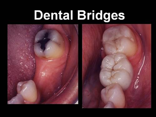 What are Bridges 1