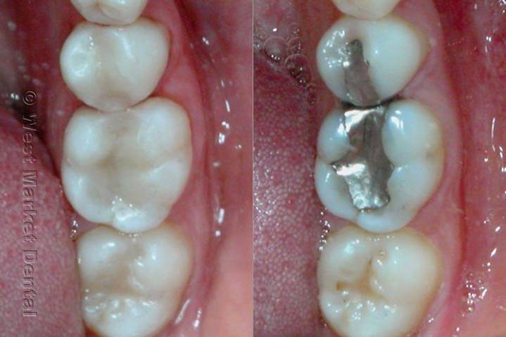 What are Fillings 1