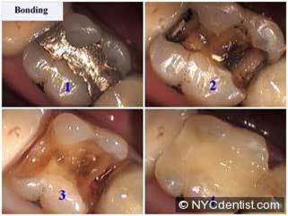 What are Fillings 2