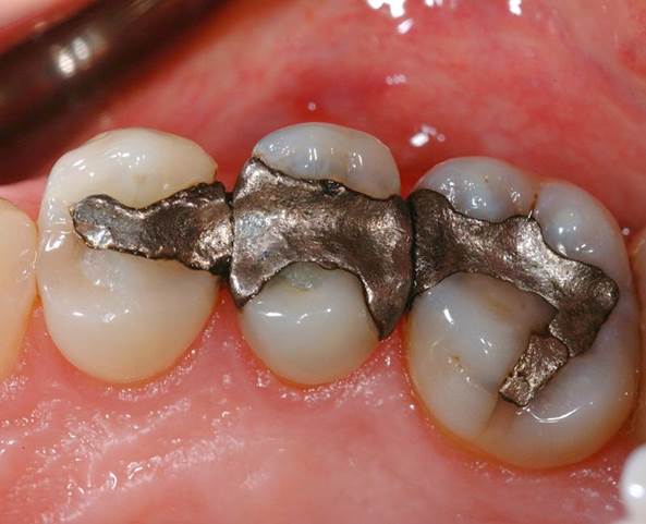 What are Fillings 4