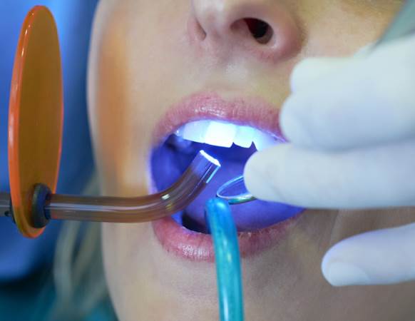 What are Fillings 5