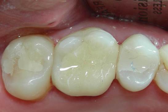 What are Fillings 6