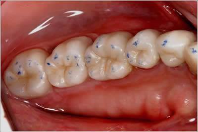 What are Fillings 8