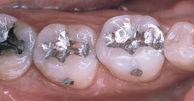 What are Fillings 9