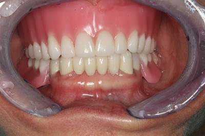 What are Partial Dentures 10