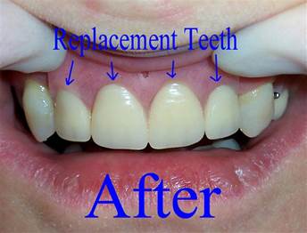 What are Partial Dentures 11