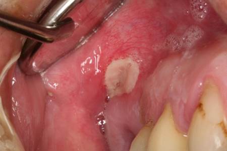 What are Partial Dentures 12