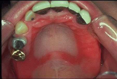 What are Partial Dentures 13