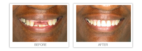 What are Partial Dentures 14