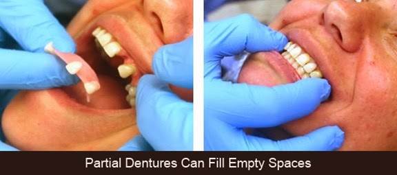 What are Partial Dentures 4