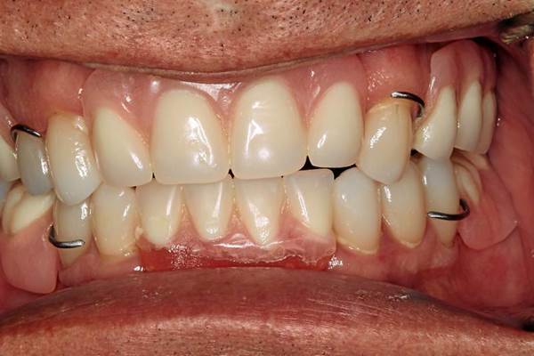 What are Partial Dentures 5