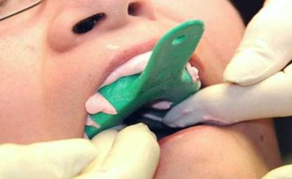 What are Partial Dentures 9
