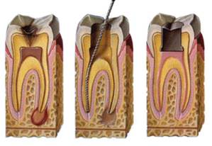 What are Root Canals 1