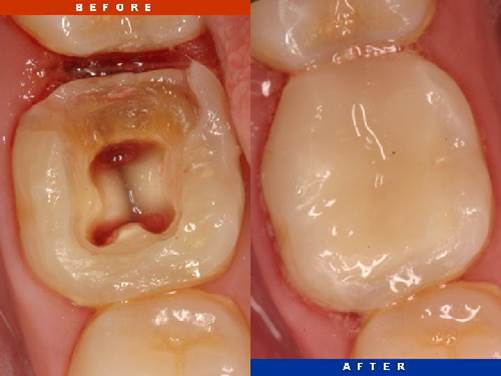 What are Root Canals 11