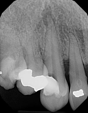 What are Root Canals 12