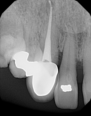 What are Root Canals 13