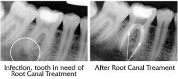What are Root Canals 2