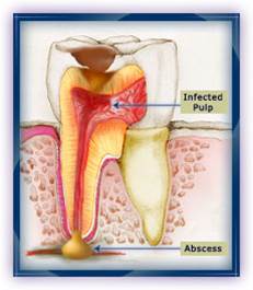 What are Root Canals 3