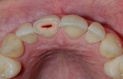 What are Root Canals 4