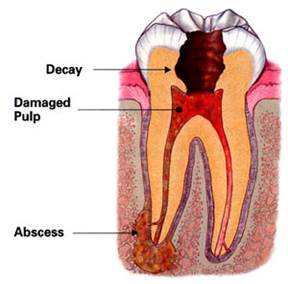 What are Root Canals 5