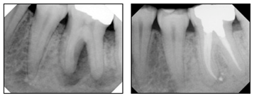 What are Root Canals 6