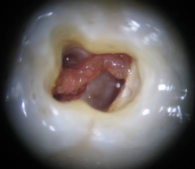 What are Root Canals 8