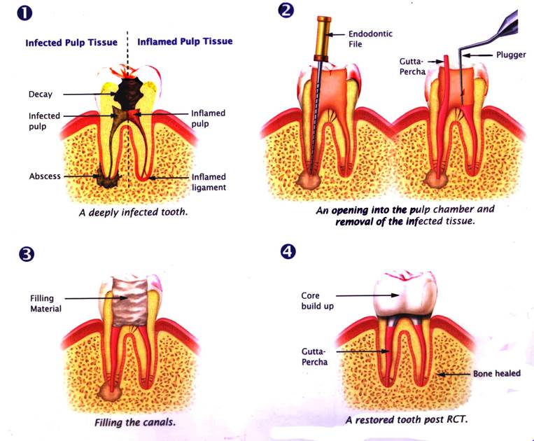 What are Root Canals 9