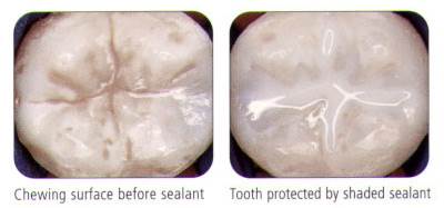 What are Sealants 2