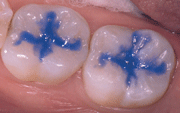 What are Sealants 4