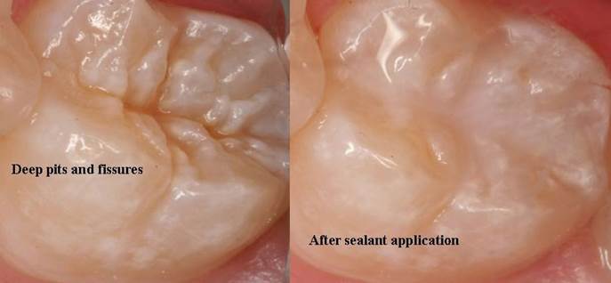 What are Sealants 7