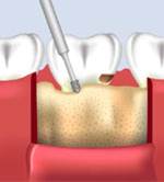 What is Crown Lengthening 1