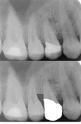 What is Crown Lengthening 2