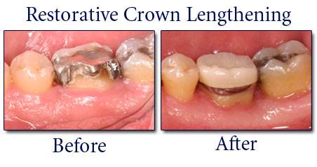 What is Crown Lengthening 3