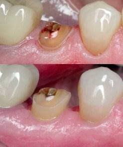 What is Crown Lengthening 4